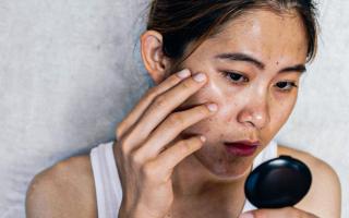   Thấu hiểu làn da sạm nám cùng dược mỹ phẩm Pháp MD Cosmedi