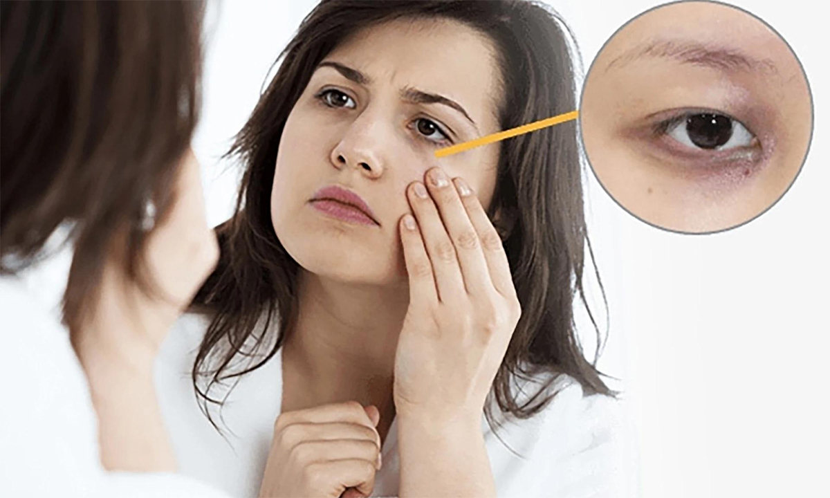 “Trẻ trung hơn từ ánh nhìn” - Bí quyết xóa thâm, trẻ hóa mắt toàn diện bằng Teoxane tại NADi Việt Nam